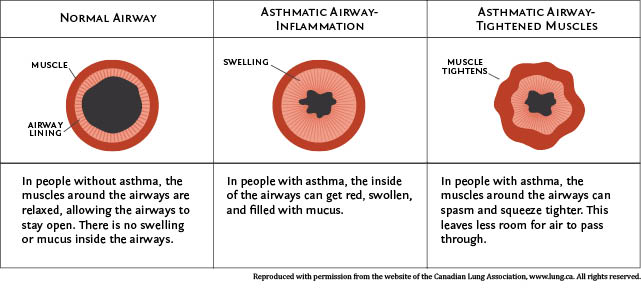 Normal and Asthma Lung Airways: In people without asthma the muscles around the airways are relaxed and there is no swelling or mucus.  In people with asthma the airways can get swollen, filled with mucus and the muscles around the airways can spasm and squeeze tighter.